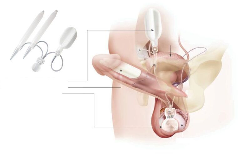 gélové implantáty v penise